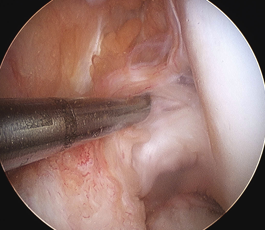 ACL Partial Torn Arthrocopy